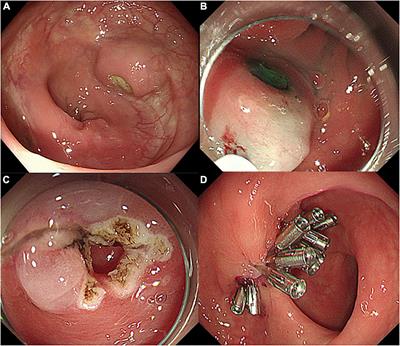 Endoscopic therapy of anastomotic diverticulum combined with stercorolith incarceration: A case report